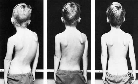 schroth-method-boy-before-and-after.jpg